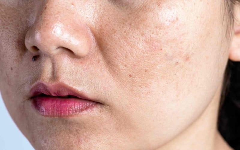 Da Nhạy Cảm, Da Sáu Điều Trị, Da Khô – Mất Nước
