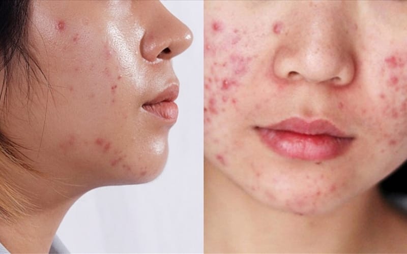 Solutions for Acne-Prone Skin