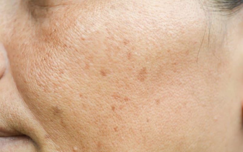 Solutions for Hyperpigmentation