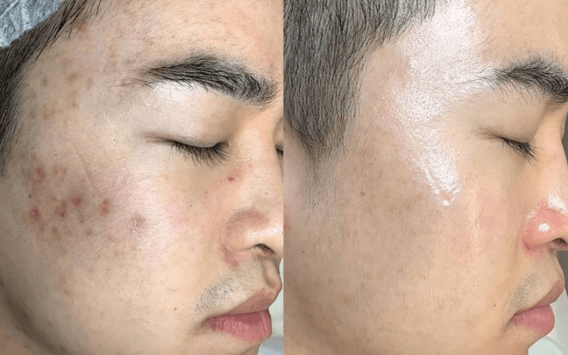 Chăm Sóc Da Sau Lột Da Mặt