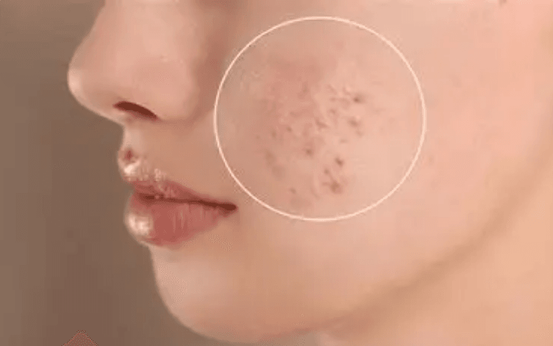 trị mụn đầu đen