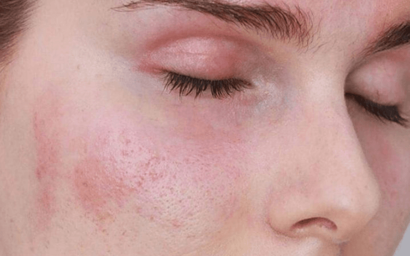 chăm sóc da mặt dị ứng