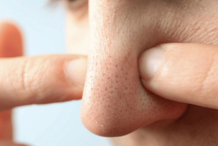 (English) Effective Ways to Treat Blackheads at Home