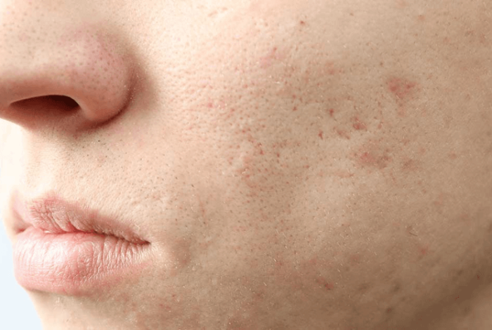 ニキビ跡の肌を徹底的かつ効果的にケアする方法