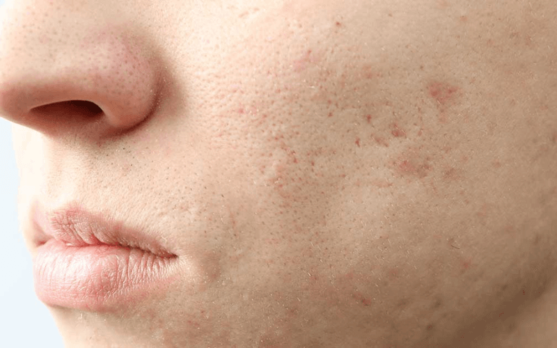cách chăm sóc da mặt bị rỗ