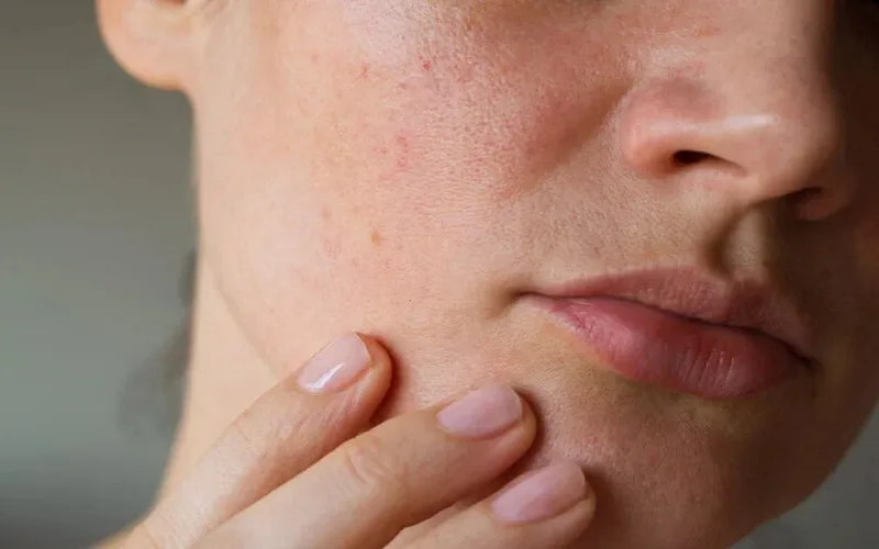 混合性皮肤护理方法