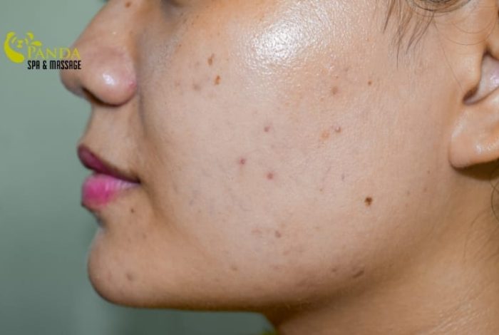 Chăm Sóc Da Dầu Đúng Cách: Kiểm Soát Nhờn, Da Khỏe Mịn