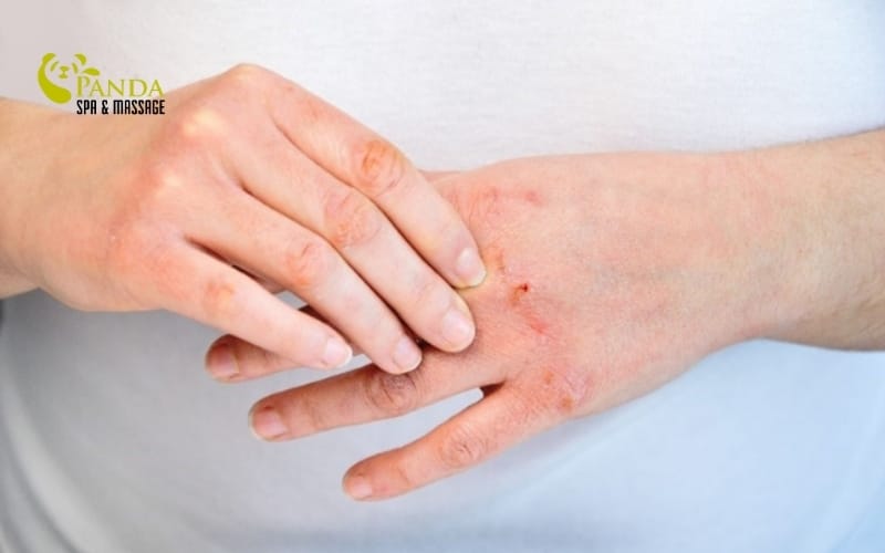 손 피부 벗겨짐