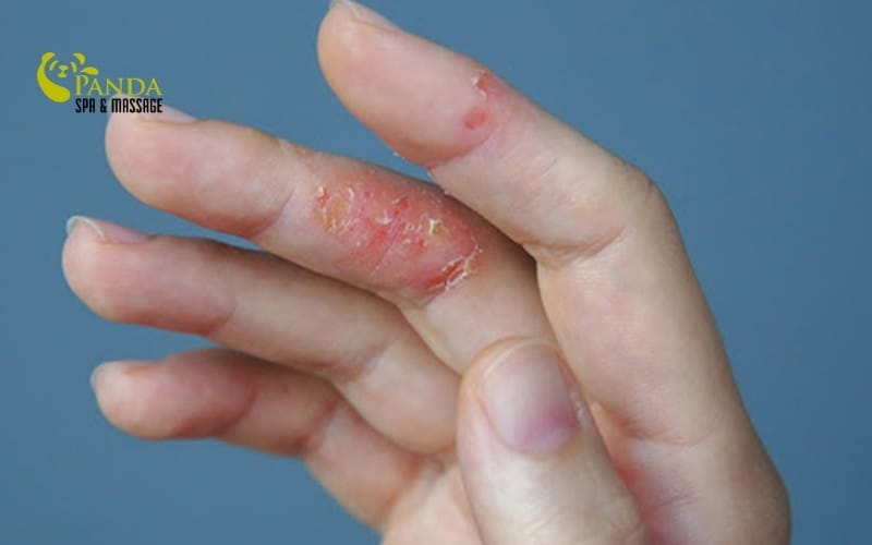 손 피부 벗겨짐