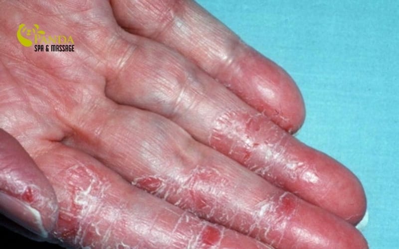 손 피부 벗겨짐