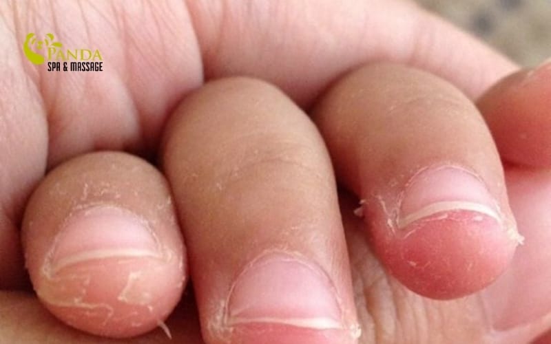 손 피부 벗겨짐