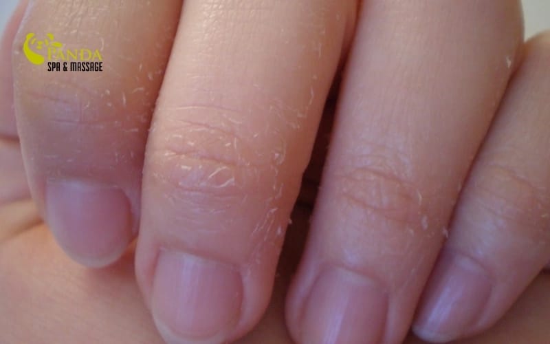 손 피부 벗겨짐