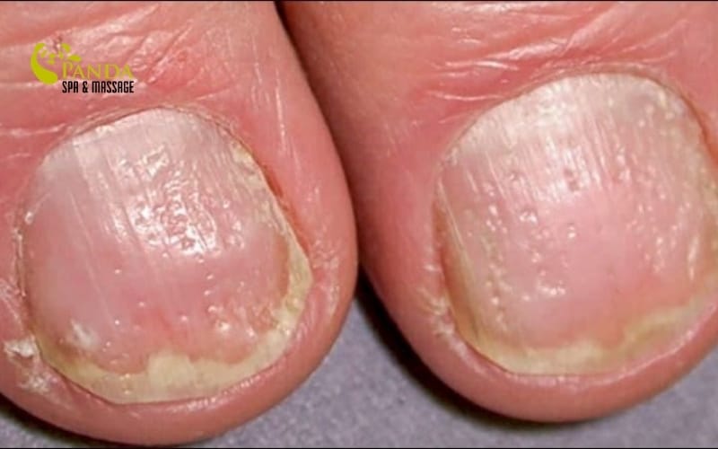 손 피부 벗겨짐