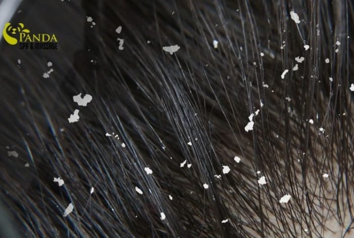 (English) How to Remove Dandruff Naturally, Safely and Effectively