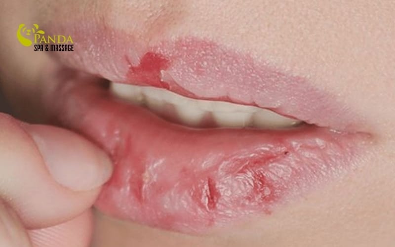 cách trị thâm môi