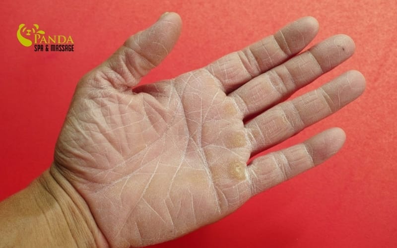 dry hand skin