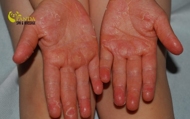 dry hand skin