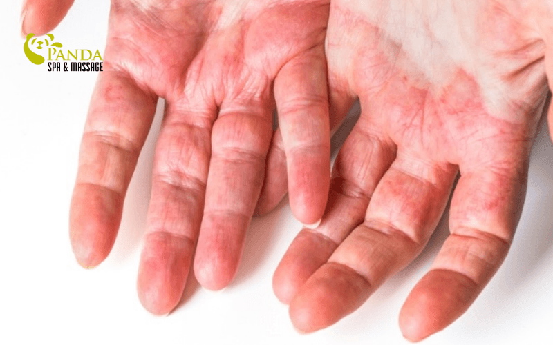 手の アレルギー