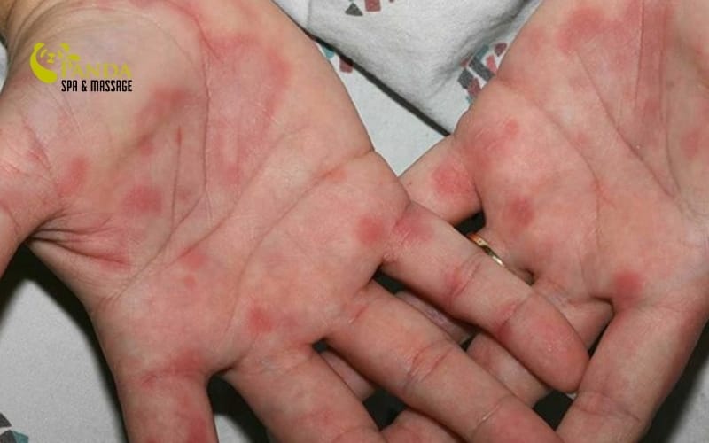 手の アレルギー