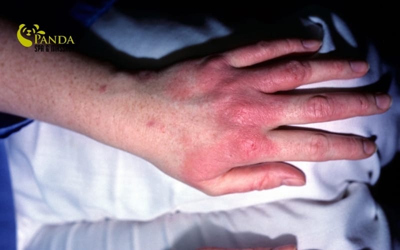 手の アレルギー