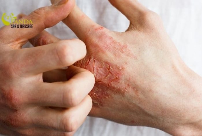(English) Hand Allergy: Causes and Safe Treatment Methods