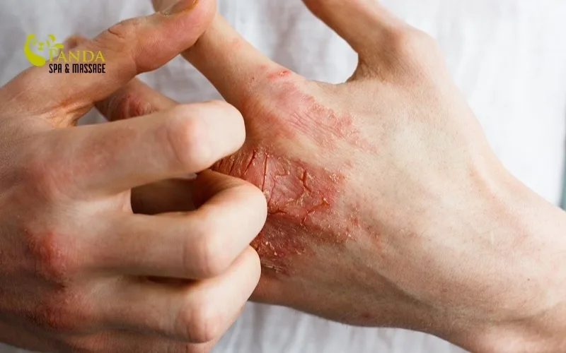 Hand Allergy: Causes and Safe Treatment Methods